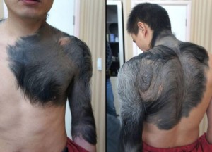 Младият мъж, получил прозвището „Шимпанзето”, моли за помощ лекарите с надеждата да се отърве от буйното окосмяване