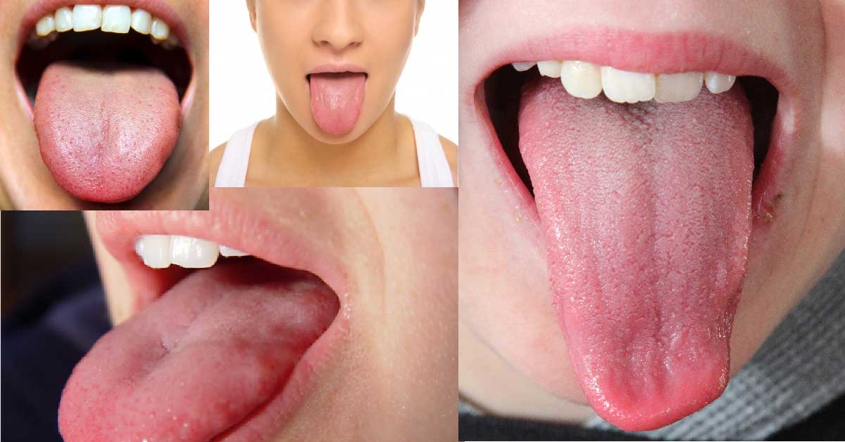 удебелен език и налепи по езика