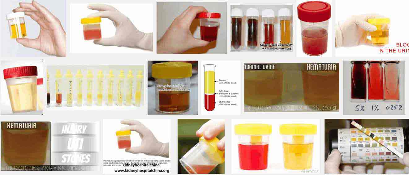 кръв в урината