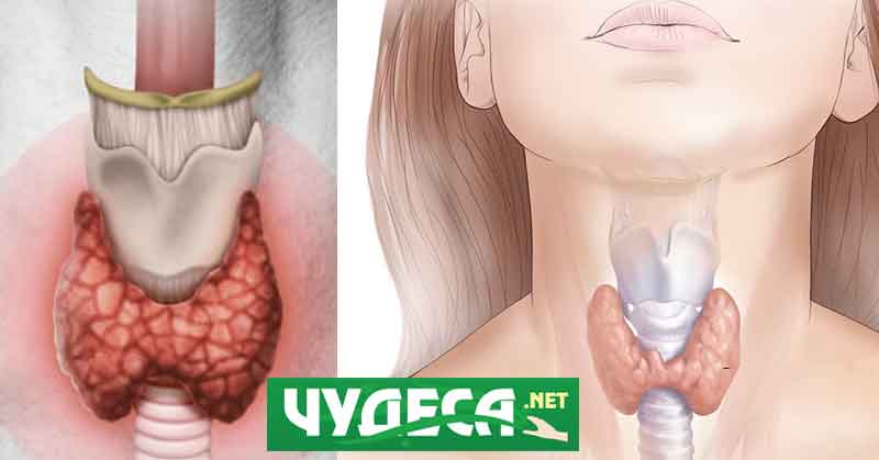 Що за болест е болестта на Хашимото?