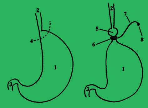 гастрален пръстен на стомаха цена - 01