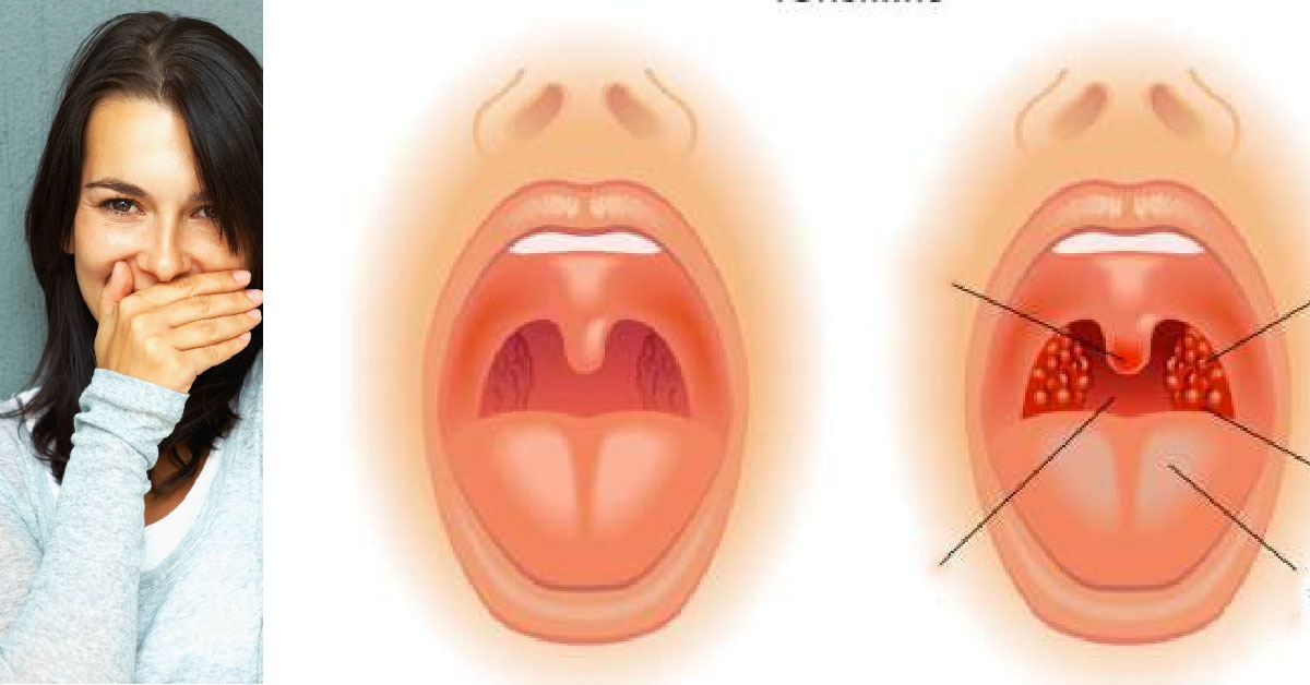 лечение на лош дъх в устата и диагностика по него