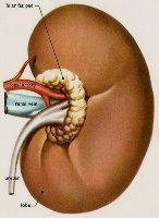 Забравен дренаж в бъбрек
