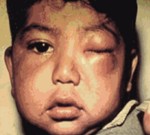 Така изглежда дете, заразено с Чагас