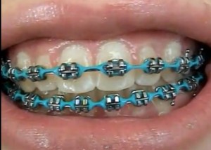 Брекетите - новата мания на тийнейджърите