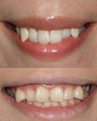 Само за $400 се сдобиваш с вампирска усмивка