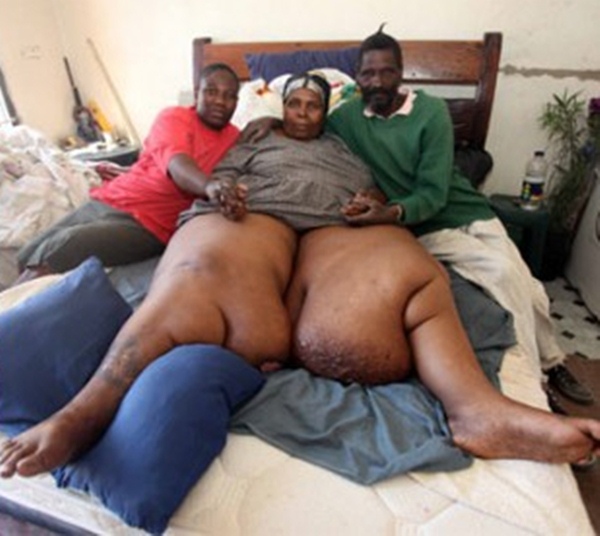 ухапване от пасекоми паразити води до страшната болест слонски крака