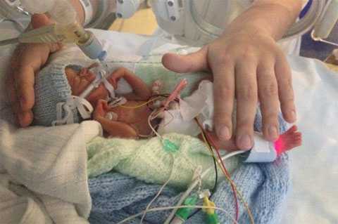 mladenec vesom v 500 gramm pobedil smert 42090 0