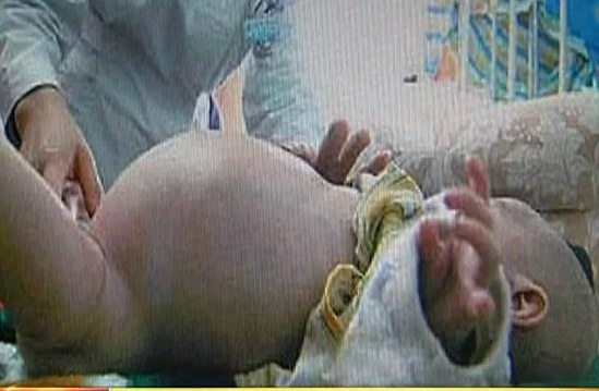 Момче роди своя брат-близнак