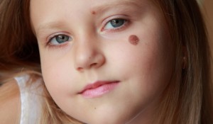 Родилните белези