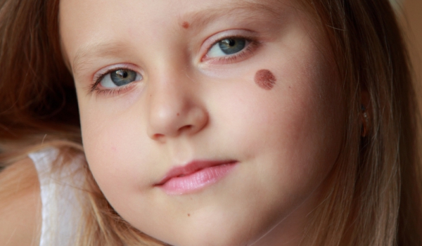 Родилните белези