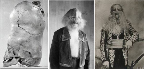 Черепът на двуглавото дете от Бенгалия и Стефан Бибровски – хора с необичайни съдби