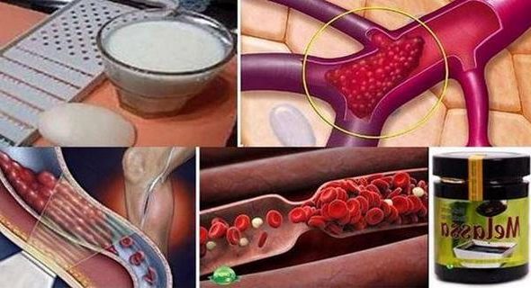 Рецепта за тромбоза – как оздравява един болен от тази опасна болест