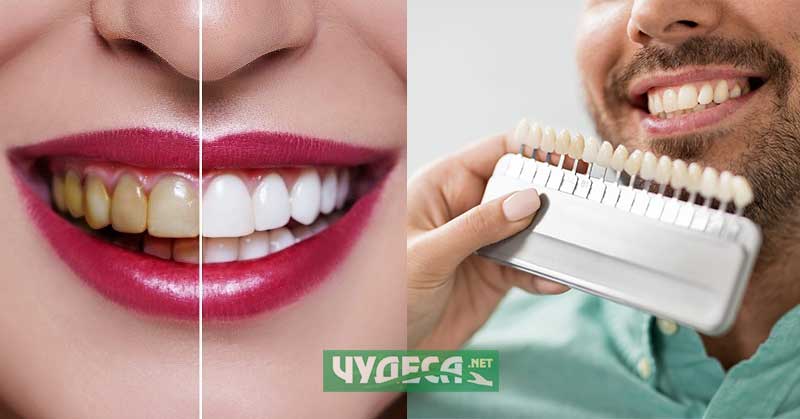 Кое е по-добро? Фасети или избелване на зъби?